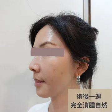 Side view photo one week after a thread lift, labeled "Swelling fully gone, natural"