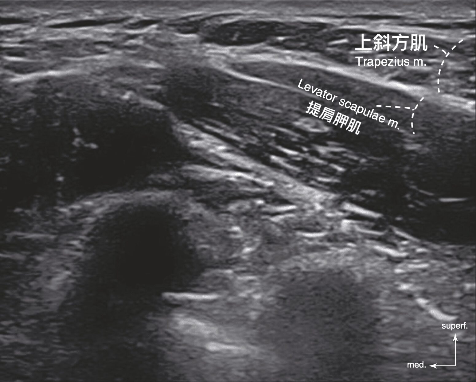 Shoulder and neck ultrasound image: the positions of the trapezius and the levator scapulae are labeled