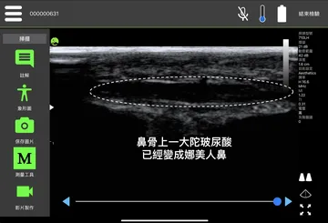 Ultrasound image labeled "a large clump of filler on the nasal bone, which has become a Na'vi nose"