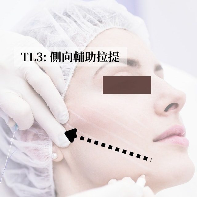 TL3 lateral supplementary lift diagram: arrows show the lateral lifting direction of the cheek threads
