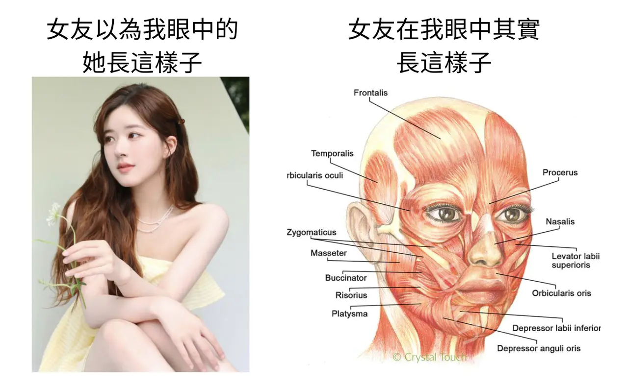 Model for the tear trough hyaluronic acid brand test: comparison of different fillers injected in different areas