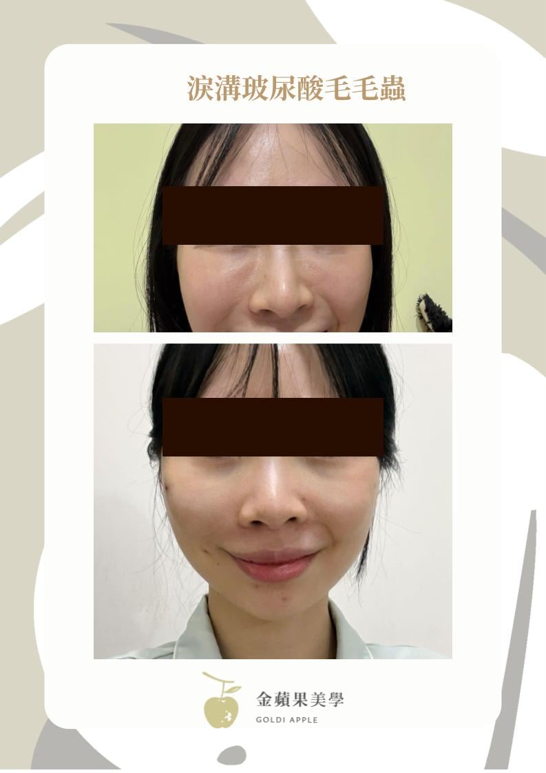 薇貝拉淚溝打太淺的後果:淚溝毛毛蟲與眼下凸起