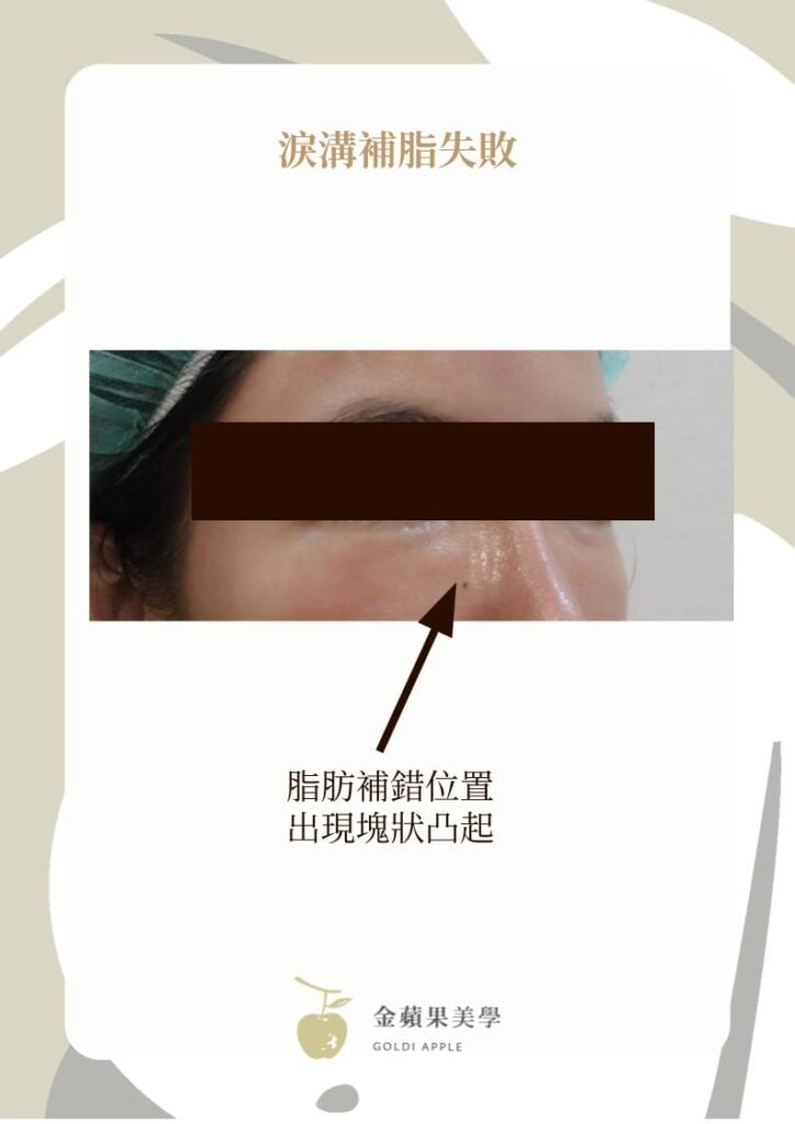 淚溝補脂失敗案例，箭頭標示脂肪補錯位置，眼下靠鼻側出現塊狀凸起