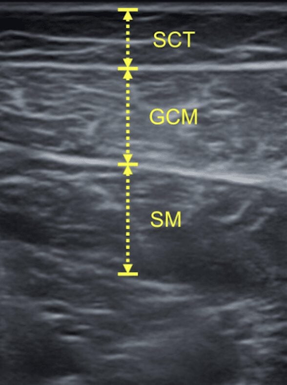 Calf ultrasound image: depth and distribution of subcutaneous fat, gastrocnemius and soleus labelled