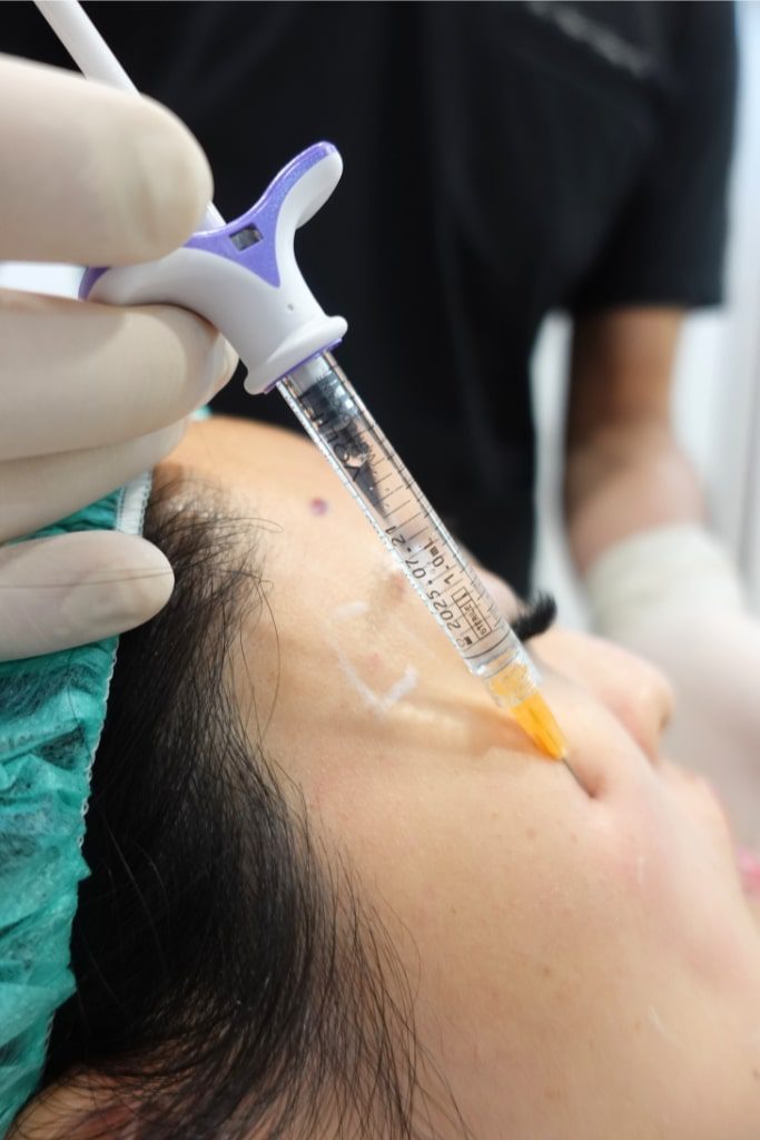 Filling hollow cheeks with Juvederm Volift and a fine blunt cannula during the procedure