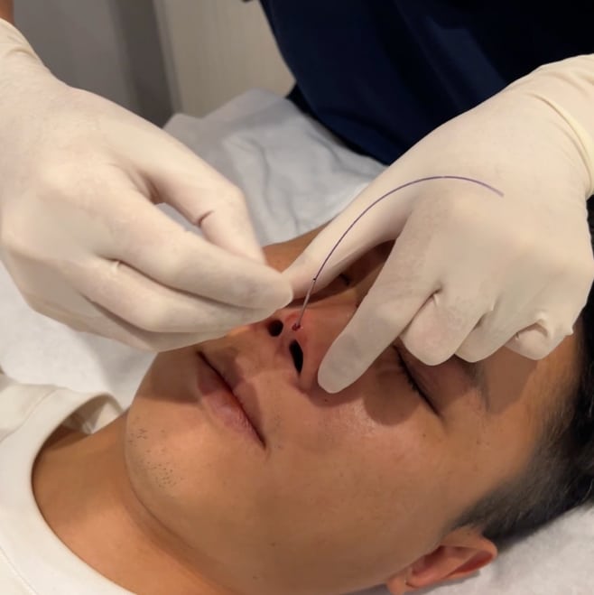 Photo of the doctor placing an arc-shaped L-shaped thread into the columella from the nasal tip