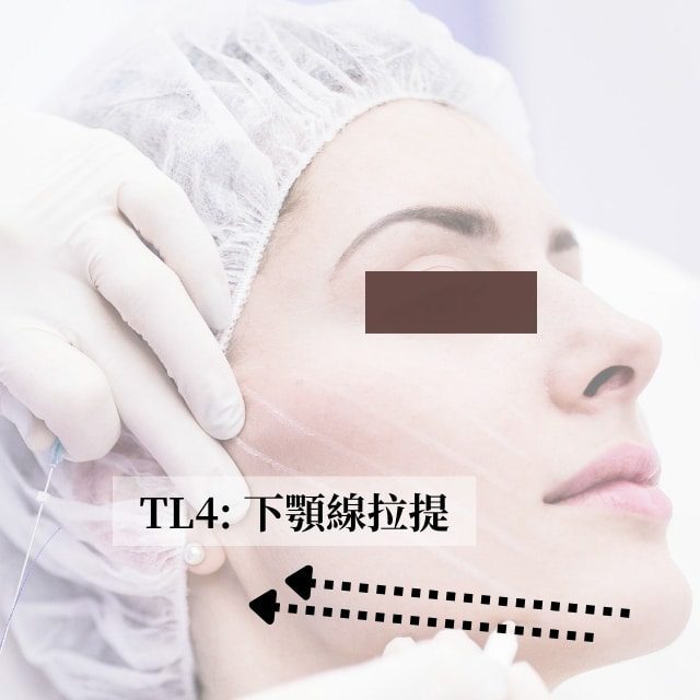 TL4 jawline lift diagram: arrows along the jawline show the thread lift direction