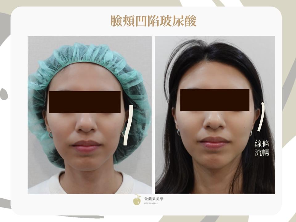 Before-and-after front view of hollow cheeks treated with 2cc hyaluronic acid plus 2cc in the temples, with the smooth contour marked