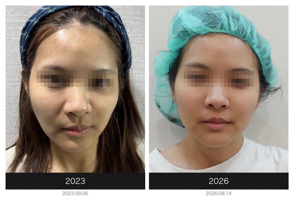 Restylane Goddess Dynamic tear trough