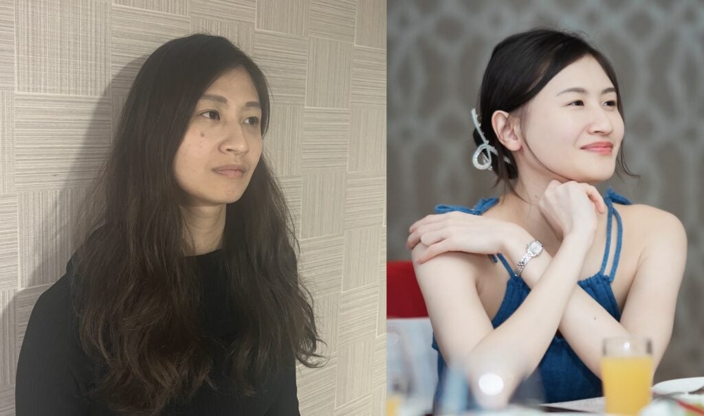 Hollow-type tear trough case: before and after comparison photos of tear trough hyaluronic acid