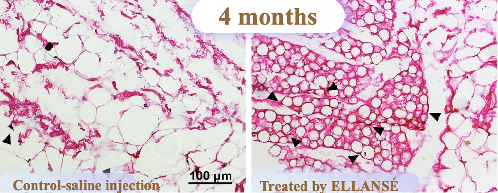 How Ellanse works: PCL stimulates collagen growth