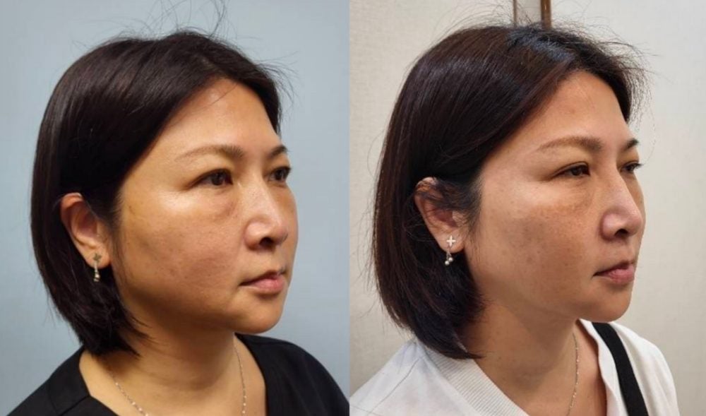 金蘋果美學診所|消除嘴邊肉案例二