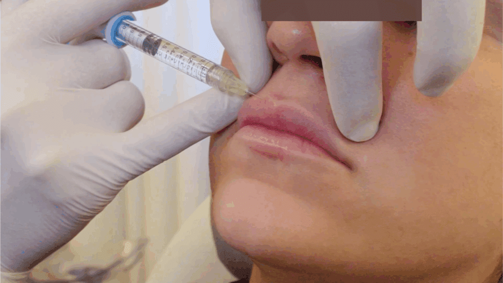 玻尿酸豐唇實際操作:醫師以細針於上唇唇峰注射塑形