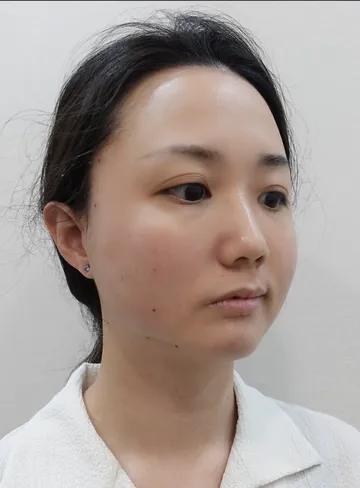 Photo of recovery after Mint Lift thread lifting: firm jawline contour with no obvious swelling or bruising