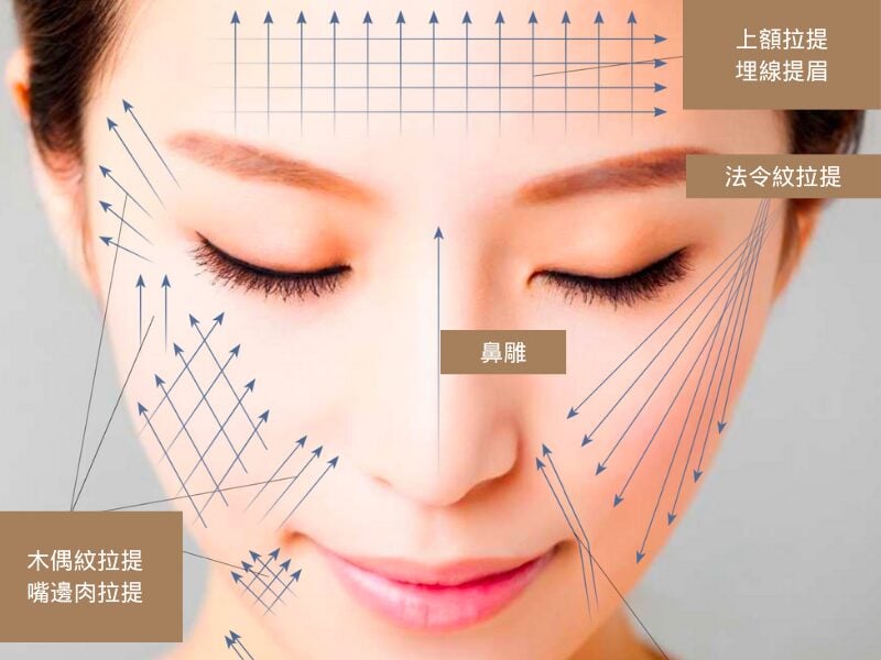 Facial thread lifting