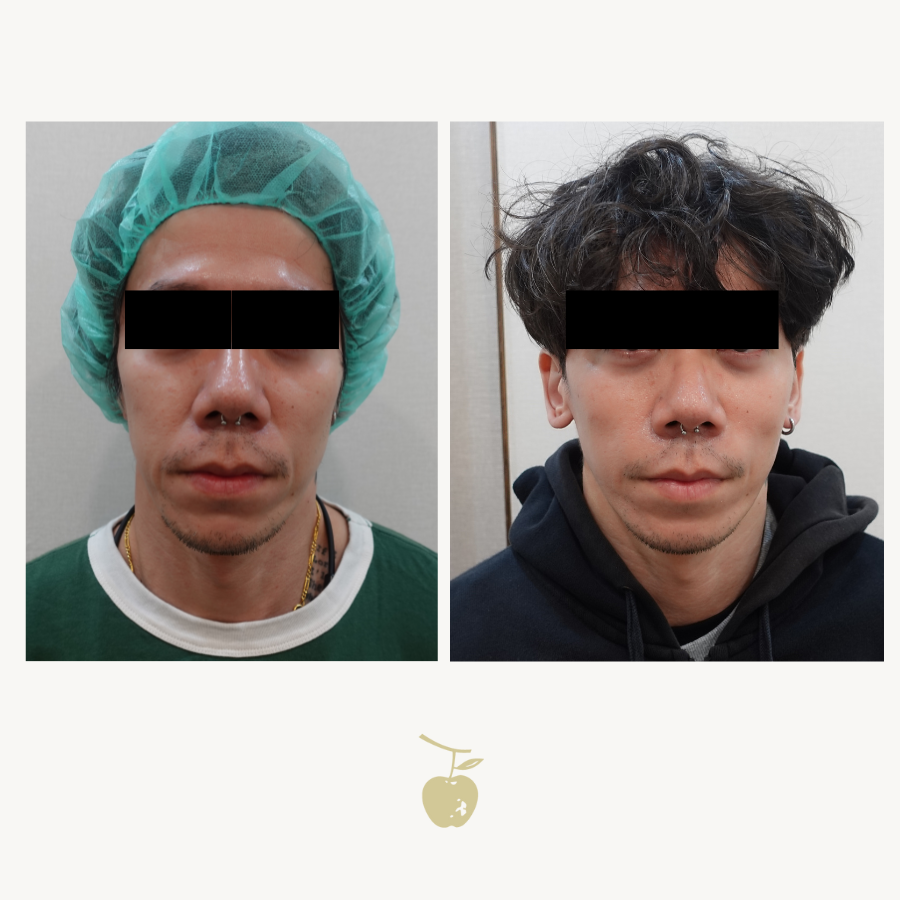 Hollow-type nasolabial folds