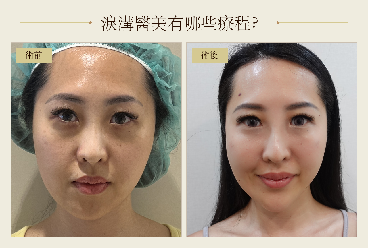 「淚溝醫美有哪些療程？」標題圖，女性淚溝治療術前術後正面對比
