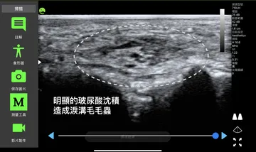 Ultrasound image labeled "obvious filler deposit causing a tear-trough caterpillar," with a dotted line circling the lump