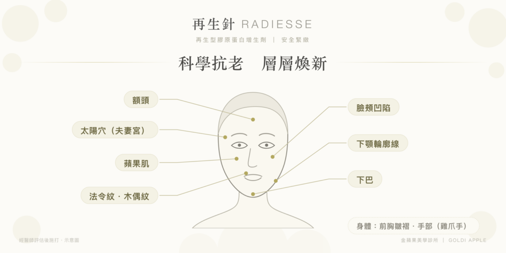 Radiesse treatment areas: forehead, temples, apple cheeks, nasolabial folds, hollow cheeks, jawline, chin