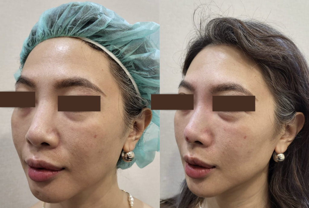 Before and after side-profile photos of two women, illustrating what to do when the nasal root widens after filler