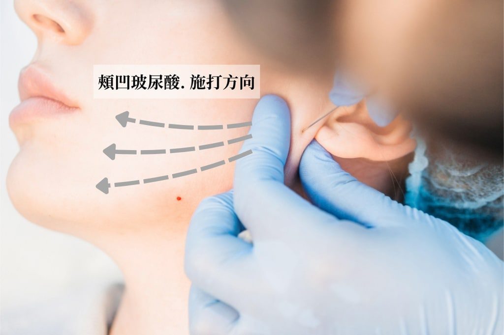 Illustration of the injection direction for hollow cheek hyaluronic acid: entering in front of the tragus, with the blunt cannula filling forward in a fan pattern