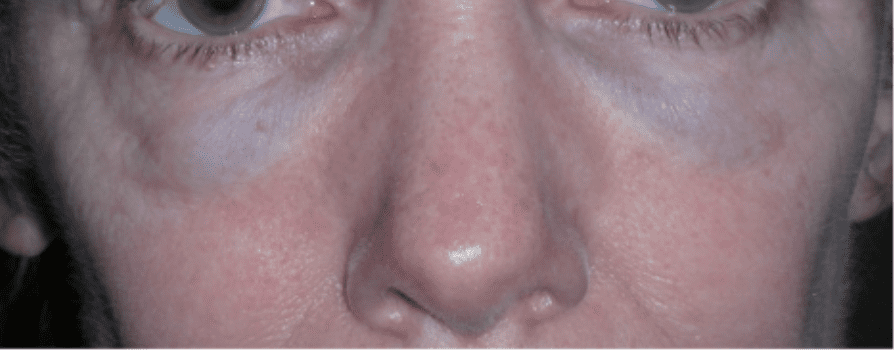 Tyndall effect caused by tear trough hyaluronic acid placed too shallow: bluish under the eye