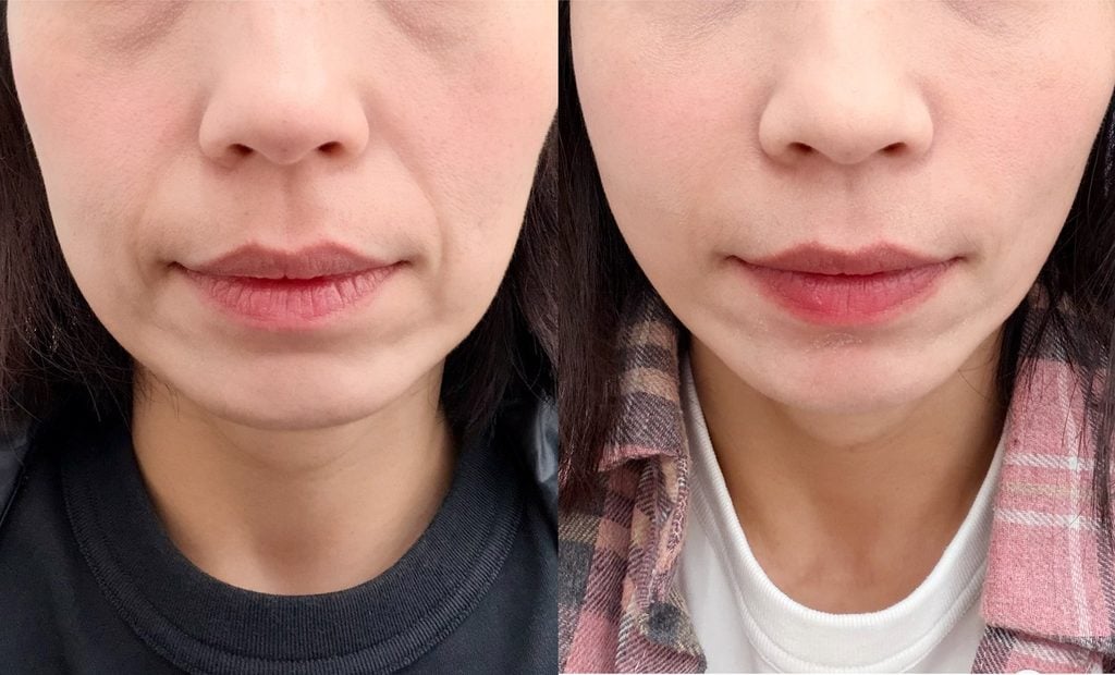Combined nasolabial fold thread lift and hyaluronic acid treatment