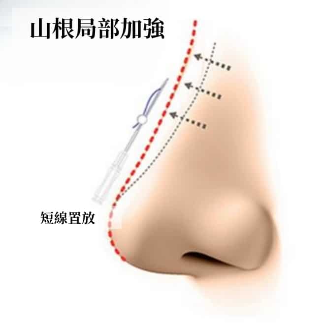 Thread rhinoplasty