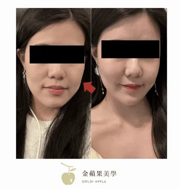 Before-and-after oblique side view of sagging-type hollow cheeks treated with a thread lift, with an arrow marking the cheek area
