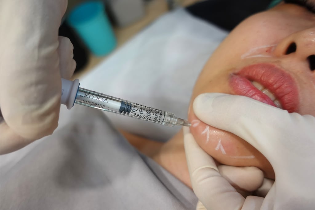 A doctor holding a Juvederm Volux syringe, injecting along the marked chin line to shape it