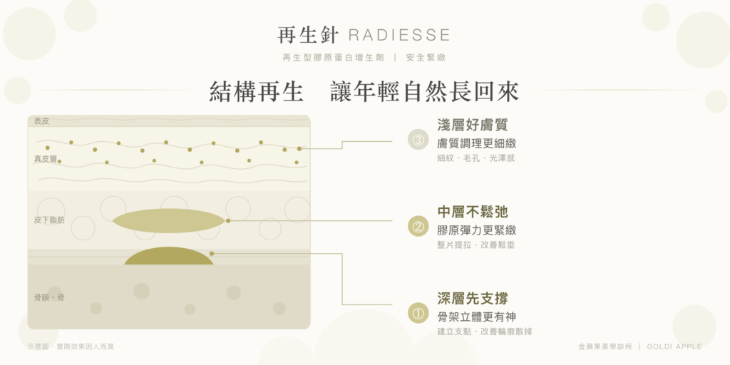 Radiesse structural regeneration diagram: deep periosteal support, mid-layer firming and superficial collagen renewal
