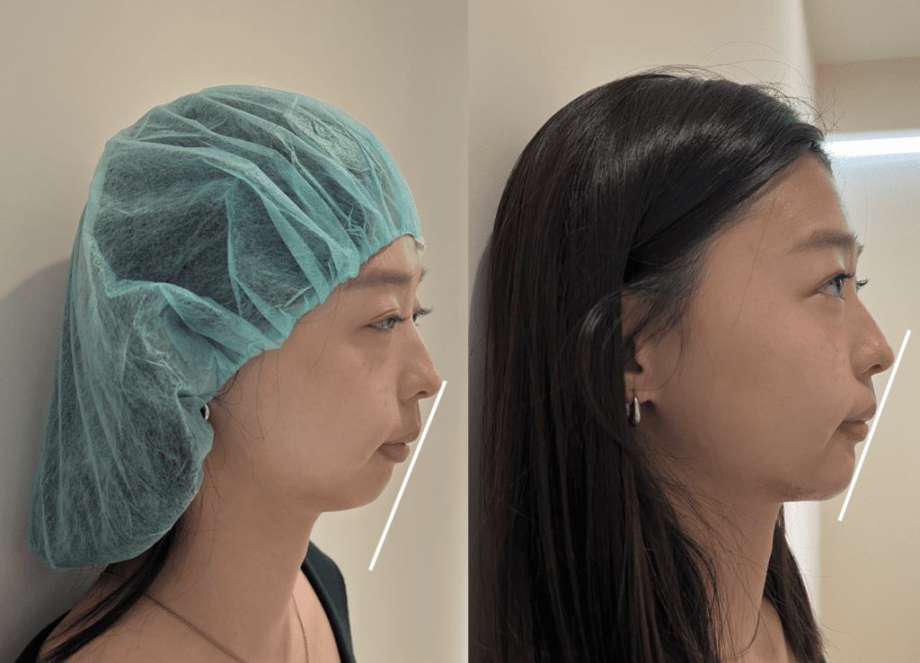 Chin hyaluronic acid