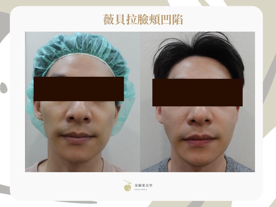 Vivabella hollow cheek treatment case: front-view side-by-side comparison of a man three months after injection