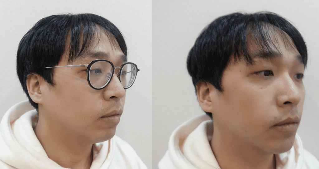 Chin hyaluronic acid for men