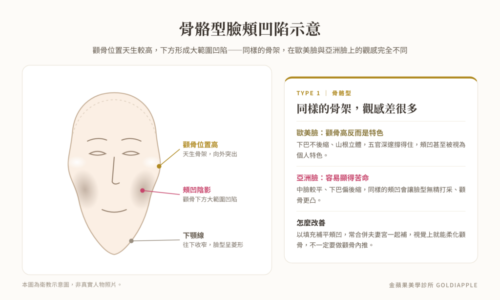 Illustration of skeletal hollow cheeks: high cheekbones, a large shadowed hollow below the cheekbone, and a narrowed jawline giving a diamond-shaped face