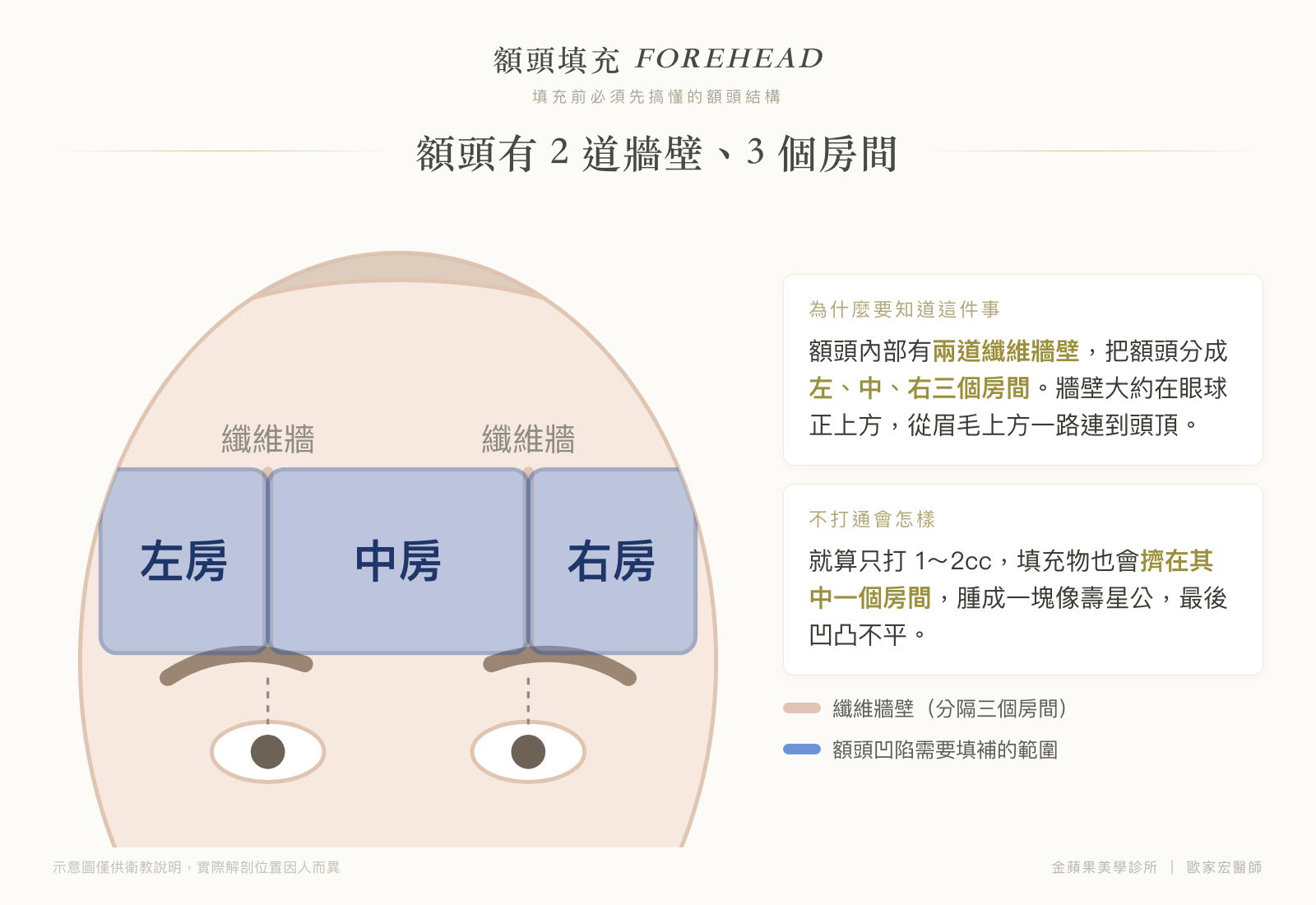 Anatomy illustration of forehead filling: two fibrous walls inside the forehead divide it into three rooms, left, middle and right, with the walls directly above the eyeballs