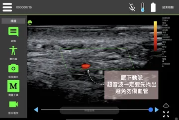 超音波影像標示眶下動脈位置，施打淚溝玻尿酸前先找出血管避免誤傷