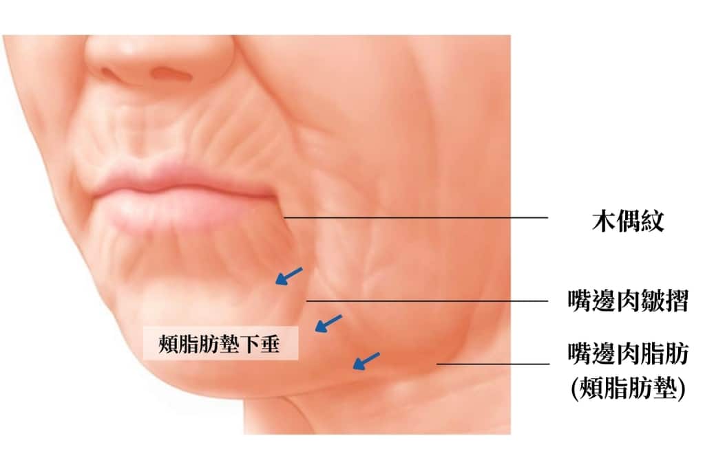 Jowls