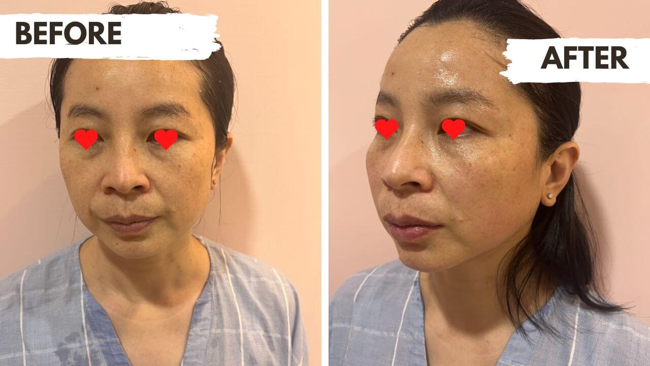 HIFU lifting before and after: photos of a woman's face labeled BEFORE and AFTER