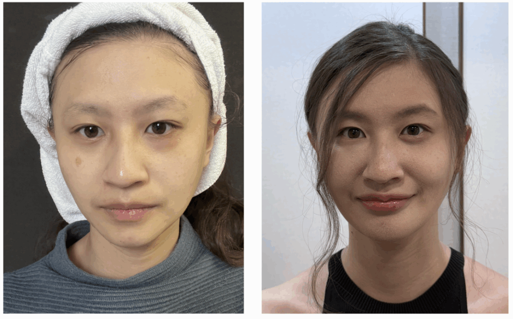 Face before and after comparison of a lip augmentation case with Restylane OBT Kysse filler