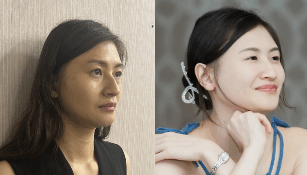 Comparison photos of a woman's face maintaining her jawline with regular HIFU lifts