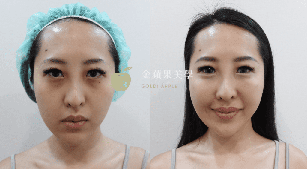 Front view of a Juvederm tear trough patient: left on the day of treatment, right at the follow-up visit