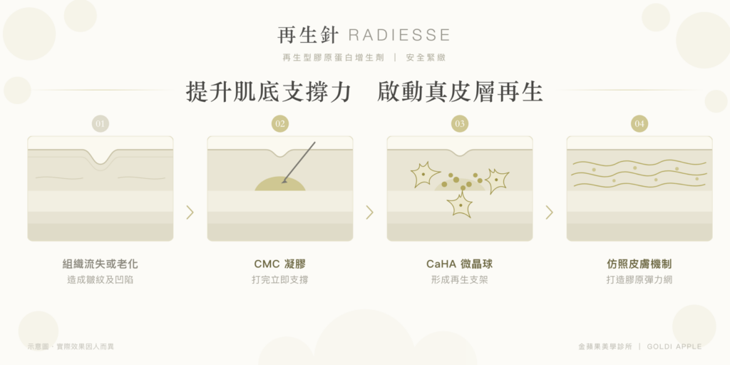 Four steps of how Radiesse works: aging hollowness, CMC gel gives immediate support, CaHA microspheres activate fibroblasts, a collagen-elastin network forms