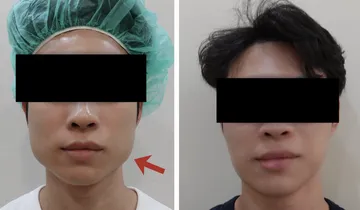 Comparison photos of a masseter botulinum toxin case, red arrows marking the masseter position