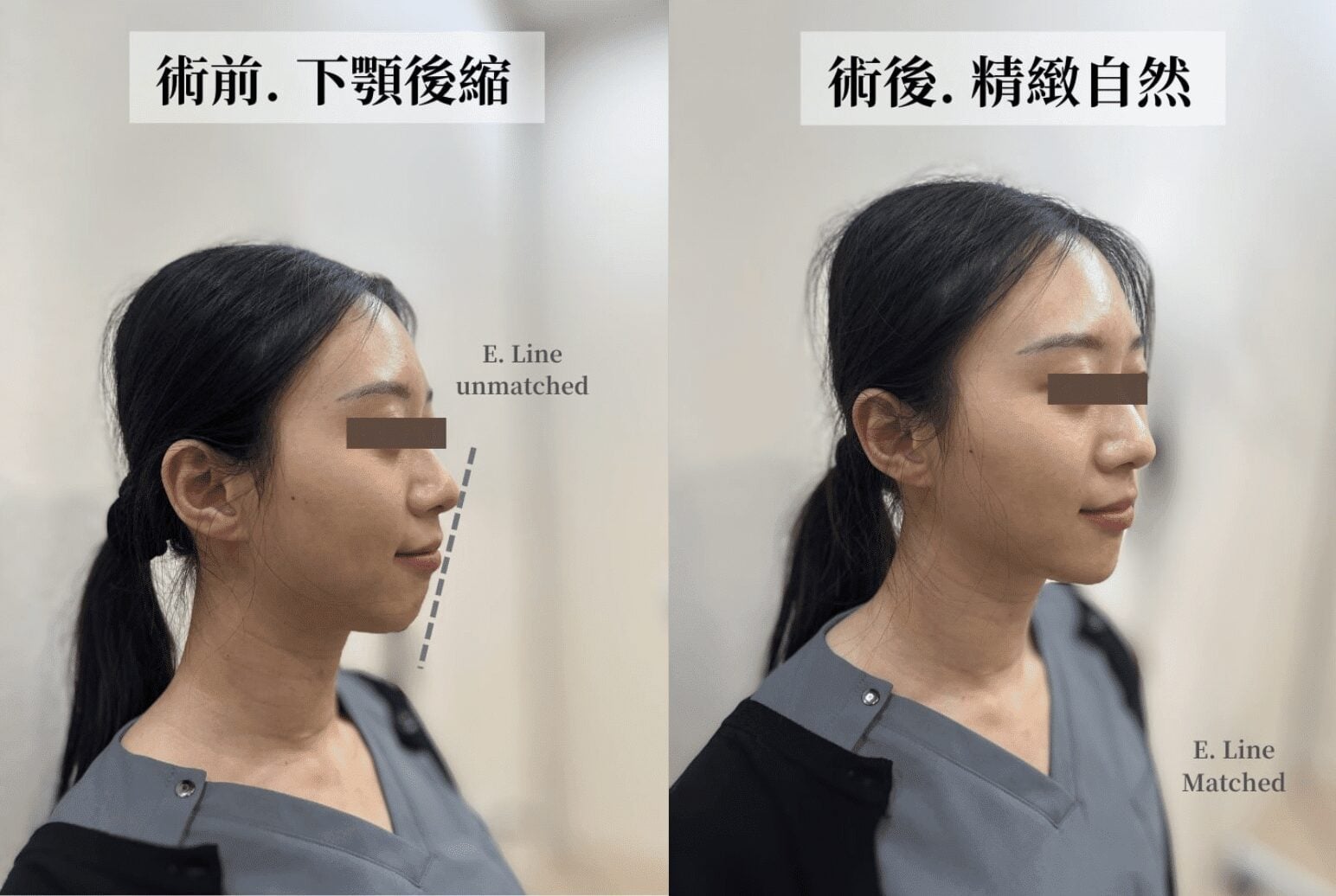 Juvederm chin
