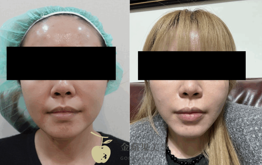 Nasolabial fold aesthetic treatment