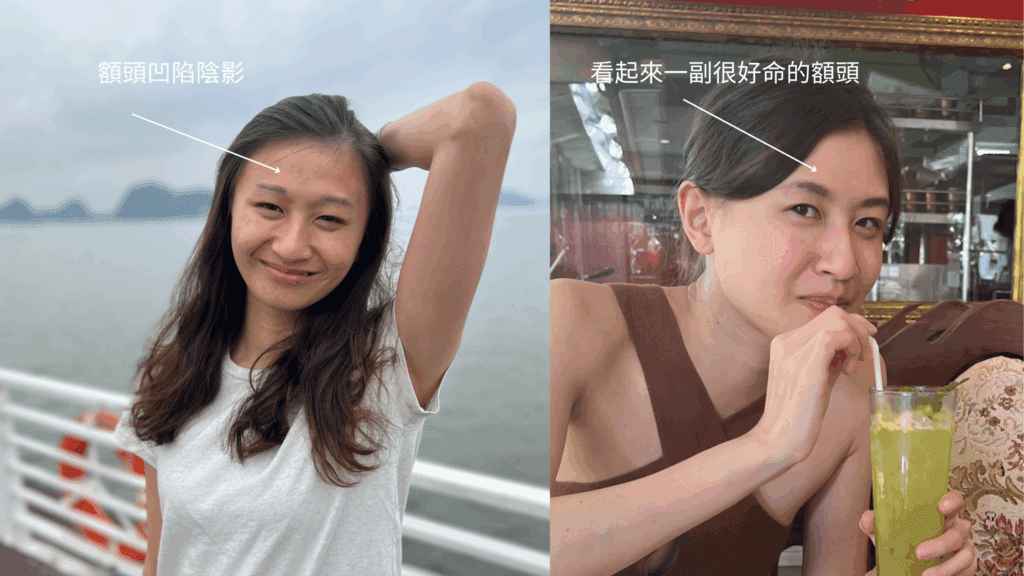 Hollow forehead vs. full forehead: on the left the hollow forehead casts a shadow, on the right the full forehead looks fortunate