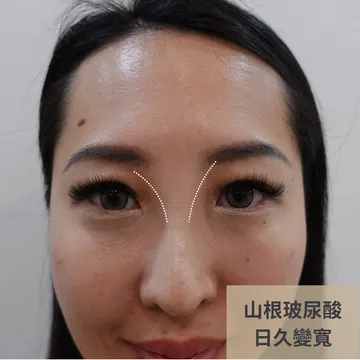 Front-view photo of a woman labeled "nose bridge filler widened over time," with dotted lines marking the widened area on both sides of the bridge