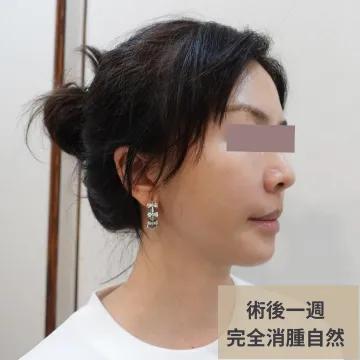 Side view photo from another angle one week after a thread lift, labeled "Swelling fully gone, natural"