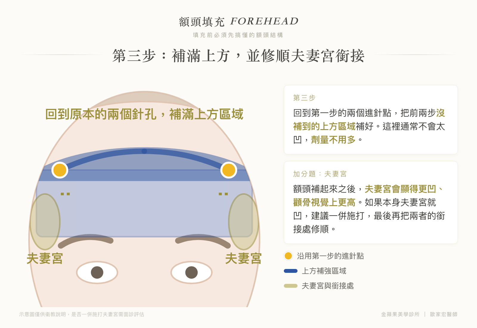 Illustration of step three of forehead filling: returning to the original two entry points to fill the upper area and smooth the junction between forehead and temples